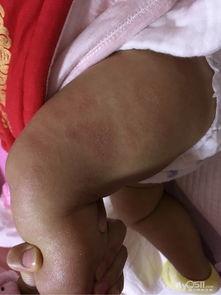 感冒过敏吃瓜好吗,吃瓜真的好吗？揭秘瓜类食物的利与弊